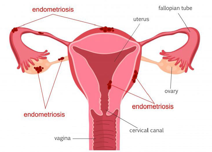 Endometriosis