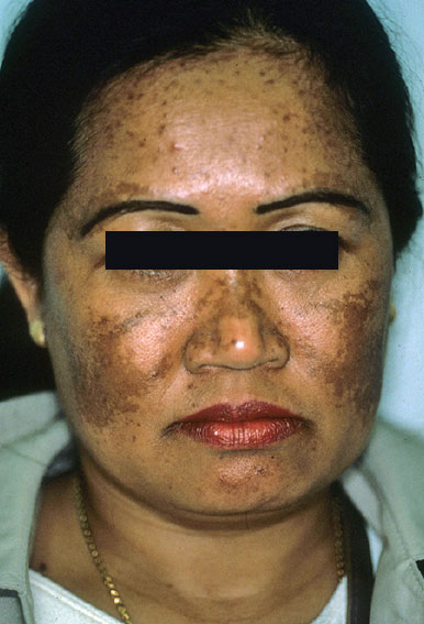 Melasma